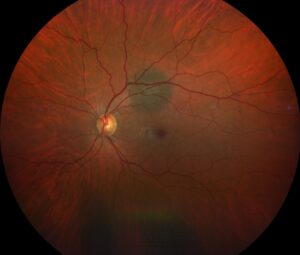 Clinical eye photograph illustrating Quinine Retinal Toxicity Signs Outcomes