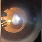 Clinical eye photograph illustrating Radiation Cataract