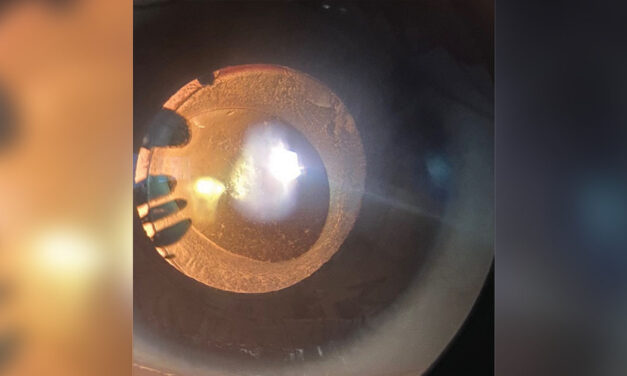 Radiation Cataract: Why the Lens Is One of the Most Radiosensitive Tissues in the Body