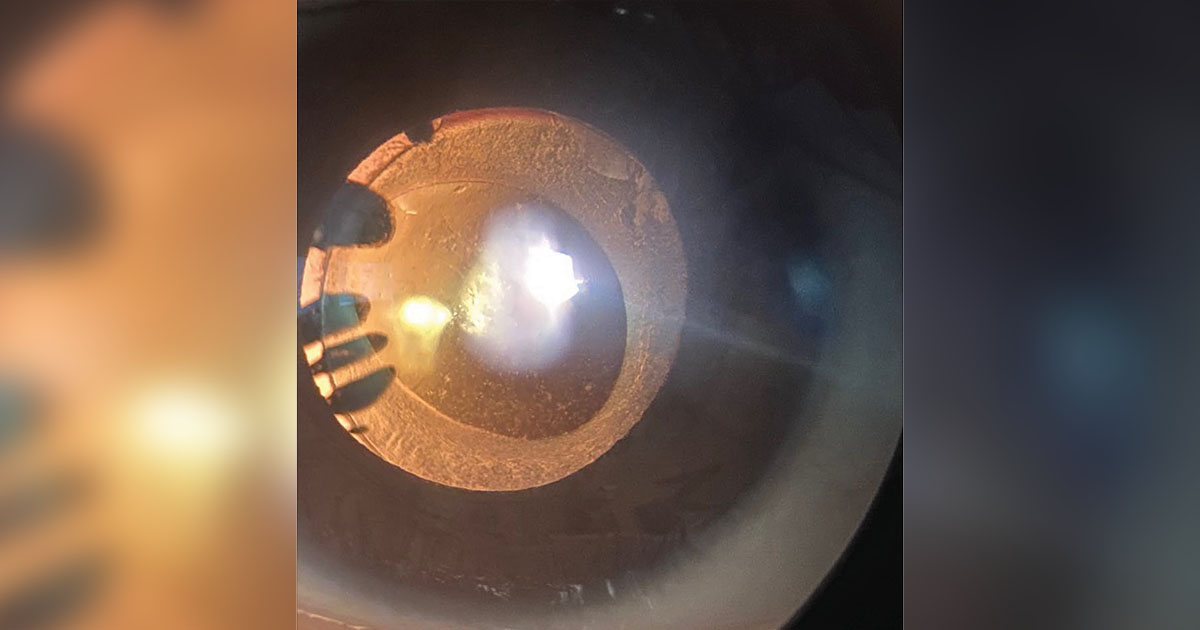 Radiation Cataract: Why the Lens Is One of the Most Radiosensitive Tissues in the Body
