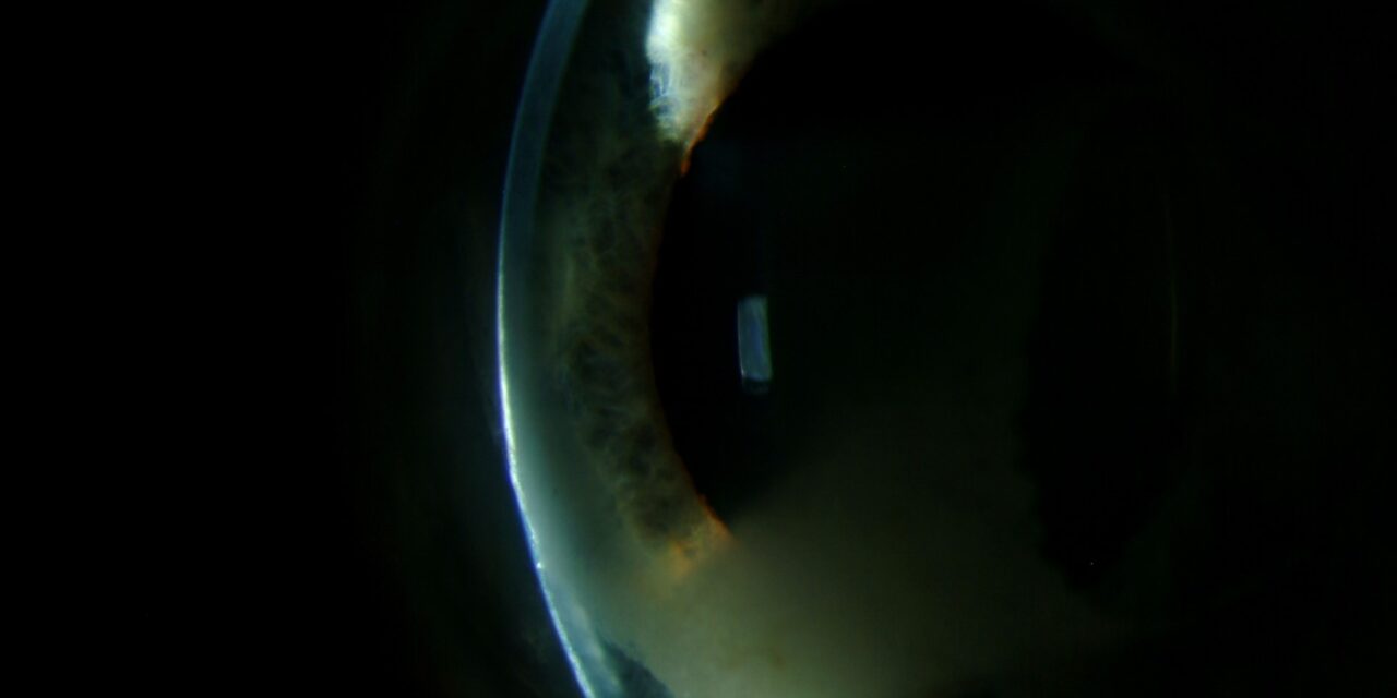 Radiation Keratopathy: A Delayed, Dose-Dependent Injury Seen Long After Treatment
