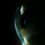 Clinical eye photograph illustrating Radiation Keratopathy