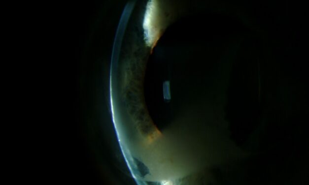 Radiation Keratopathy: A Delayed, Dose-Dependent Injury Seen Long After Treatment