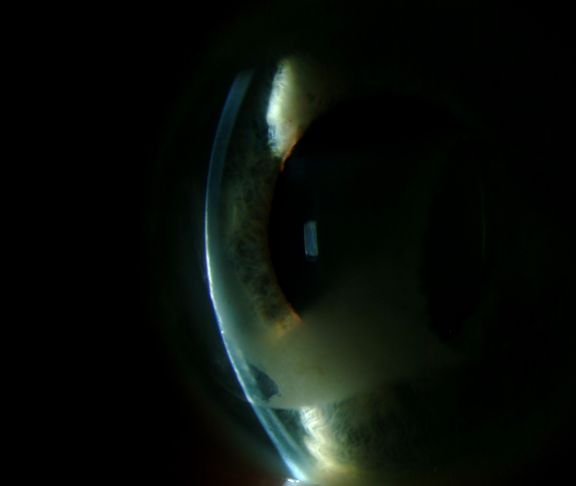 Clinical eye photograph illustrating Radiation Keratopathy