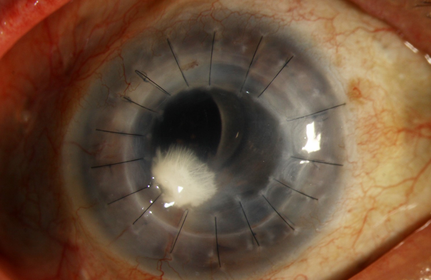Clinical eye photograph illustrating Radiation Keratopathy