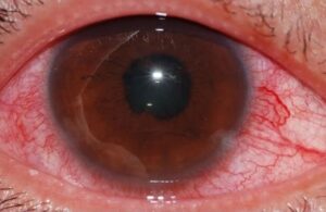 Clinical eye photograph illustrating Red Eye Differential Diagnosis Triage
