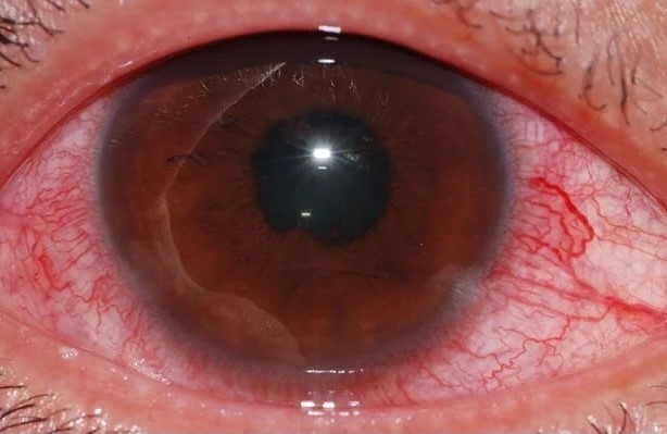 Clinical eye photograph illustrating Red Eye Differential Diagnosis Triage