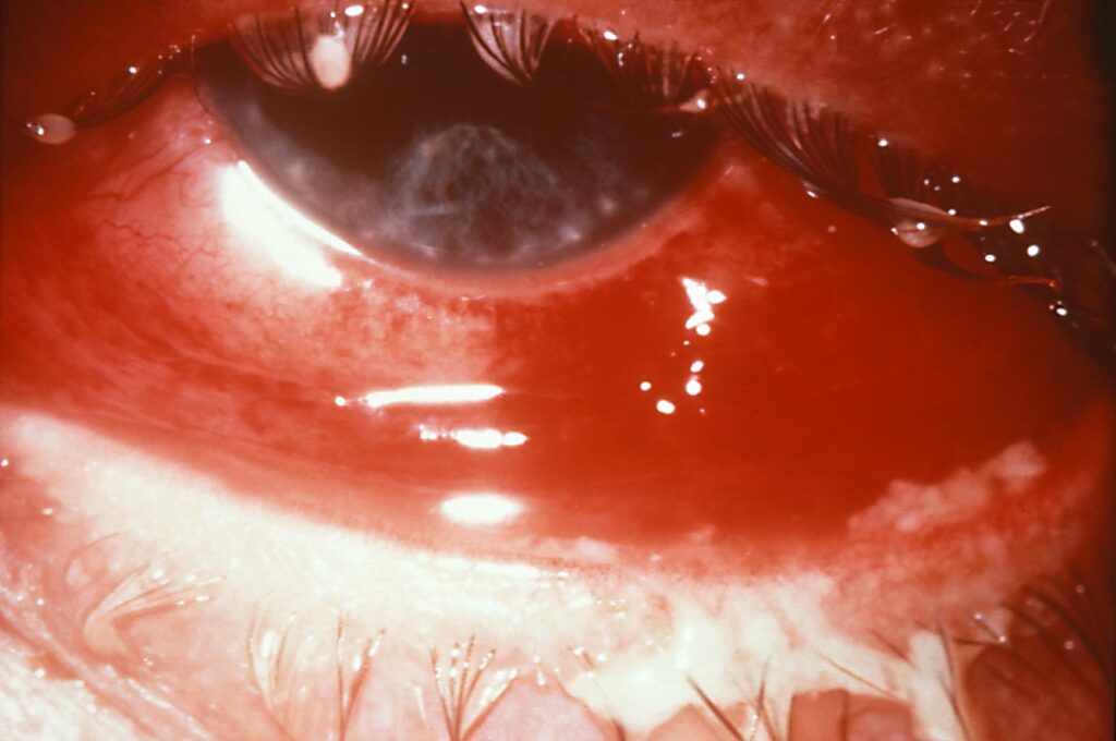 Red Eye in Children: Causes and Practical Approach