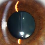 Clinical eye photograph illustrating Refractive Lens Exchange