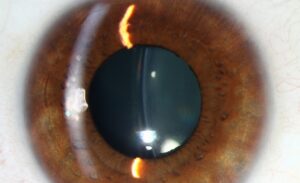 Clinical eye photograph illustrating Refractive Lens Exchange