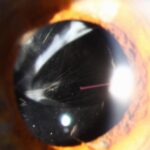 Clinical eye photograph illustrating Refractive Surprise Cataract Surgery