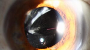 Clinical eye photograph illustrating Refractive Surprise Cataract Surgery
