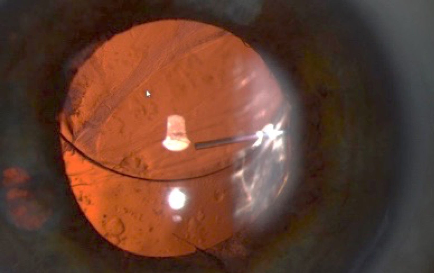 Clinical eye photograph illustrating Refractive Surprise Cataract Surgery