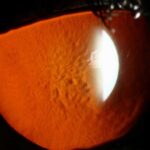 Clinical eye photograph illustrating Reis Bucklers Corneal Dystrophy