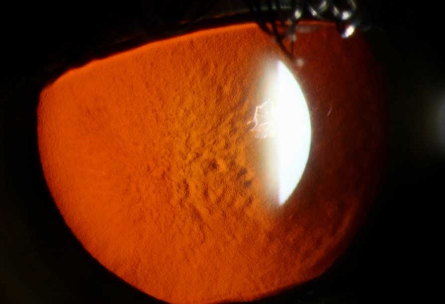 Clinical eye photograph illustrating Reis Bucklers Corneal Dystrophy