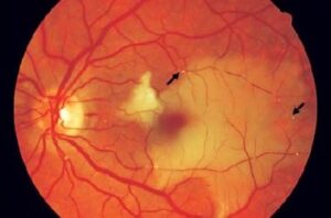 Clinical eye photograph illustrating Retinal Artery Occlusion Workup