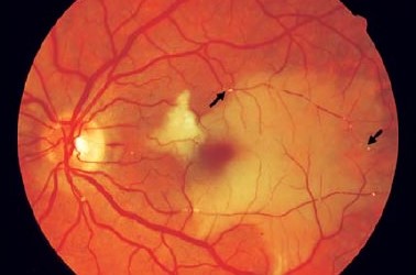 Clinical eye photograph illustrating Retinal Artery Occlusion Workup