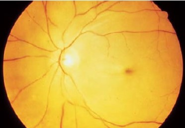 Clinical eye photograph illustrating Retinal Artery Occlusion Workup