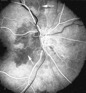 Clinical eye photograph illustrating Retinal Choroidal Watershed Zones Ischemia
