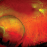 Clinical eye photograph illustrating Retinal Cysts Types Significance