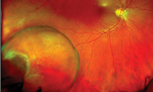 Retinal Cysts: Telling Harmless Peripheral Cavities From Ones That Matter