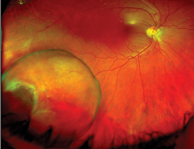 Clinical eye photograph illustrating Retinal Cysts Types Significance