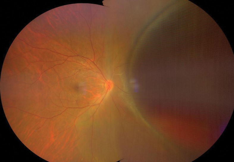 Clinical eye photograph illustrating Retinal Cysts Types Significance