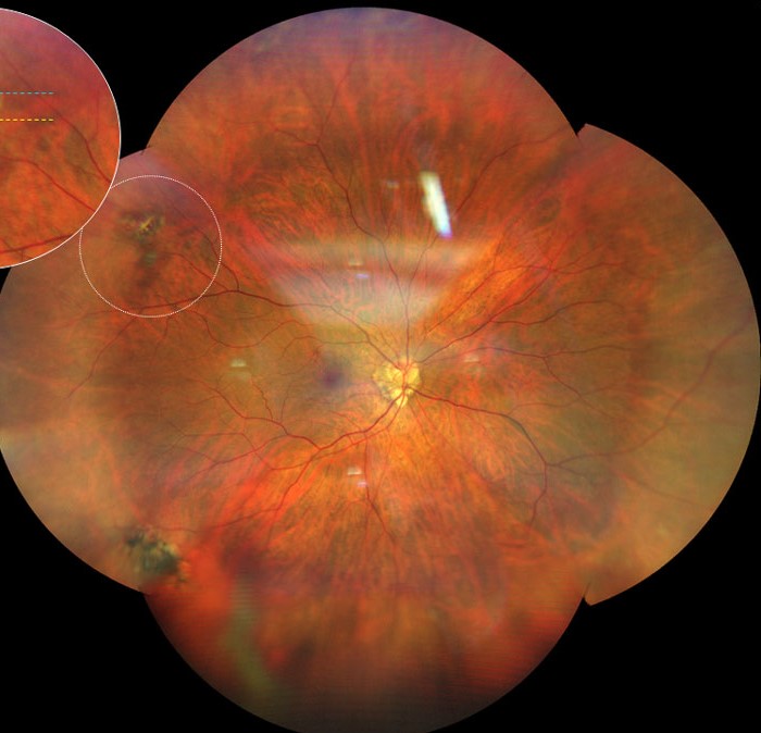 Clinical eye photograph illustrating Retinal Detachment High Myopia
