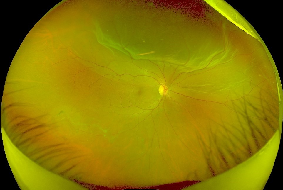Clinical eye photograph illustrating Retinal Detachment Symptoms Triage