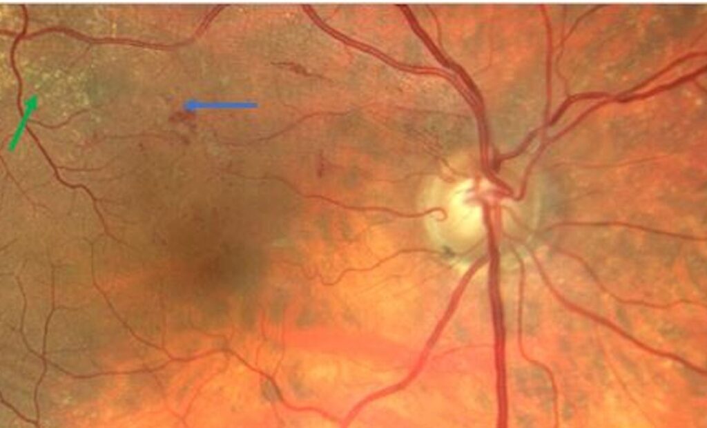 Clinical eye photograph illustrating Retinal Microaneurysms
