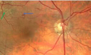 Clinical eye photograph illustrating Retinal Microaneurysms