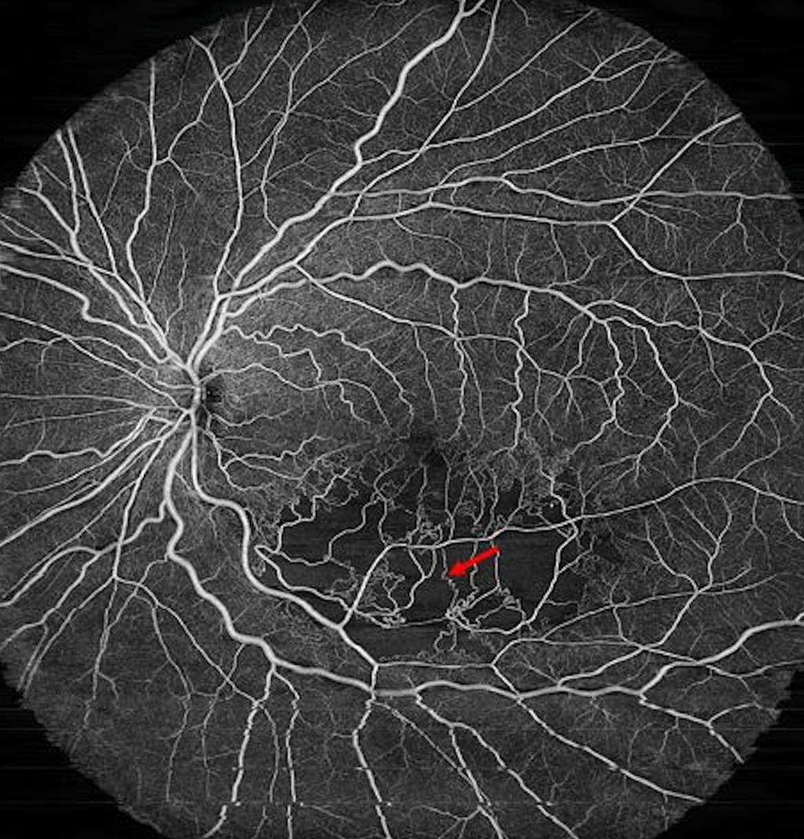 Clinical eye photograph illustrating Retinal Microaneurysms