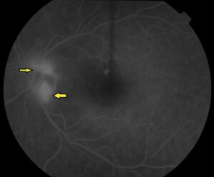 Clinical eye photograph illustrating Retinal Neovascularization Nvd Nve