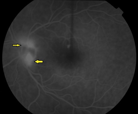 Clinical eye photograph illustrating Retinal Neovascularization Nvd Nve