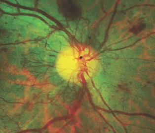 Clinical eye photograph illustrating Retinal Neovascularization Nvd Nve