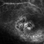 Clinical image illustrating Retinal Phototoxicity From the Operating Microscope