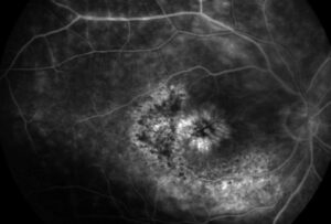 Clinical image illustrating Retinal Phototoxicity From the Operating Microscope