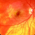 Clinical eye photograph illustrating Retinal Pigment Epithelium Window Defect
