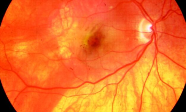 Retinal Pigment Epithelium Window Defects: When Missing Pigment Lights Up the Choroid