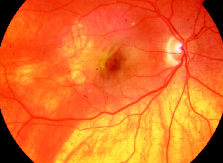 Retinal Pigment Epithelium Window Defects: When Missing Pigment Lights Up the Choroid