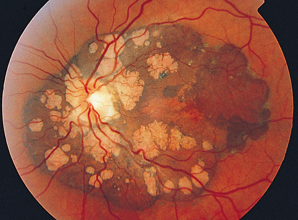 Clinical eye photograph illustrating Retinal Pigment Epithelium Window Defect