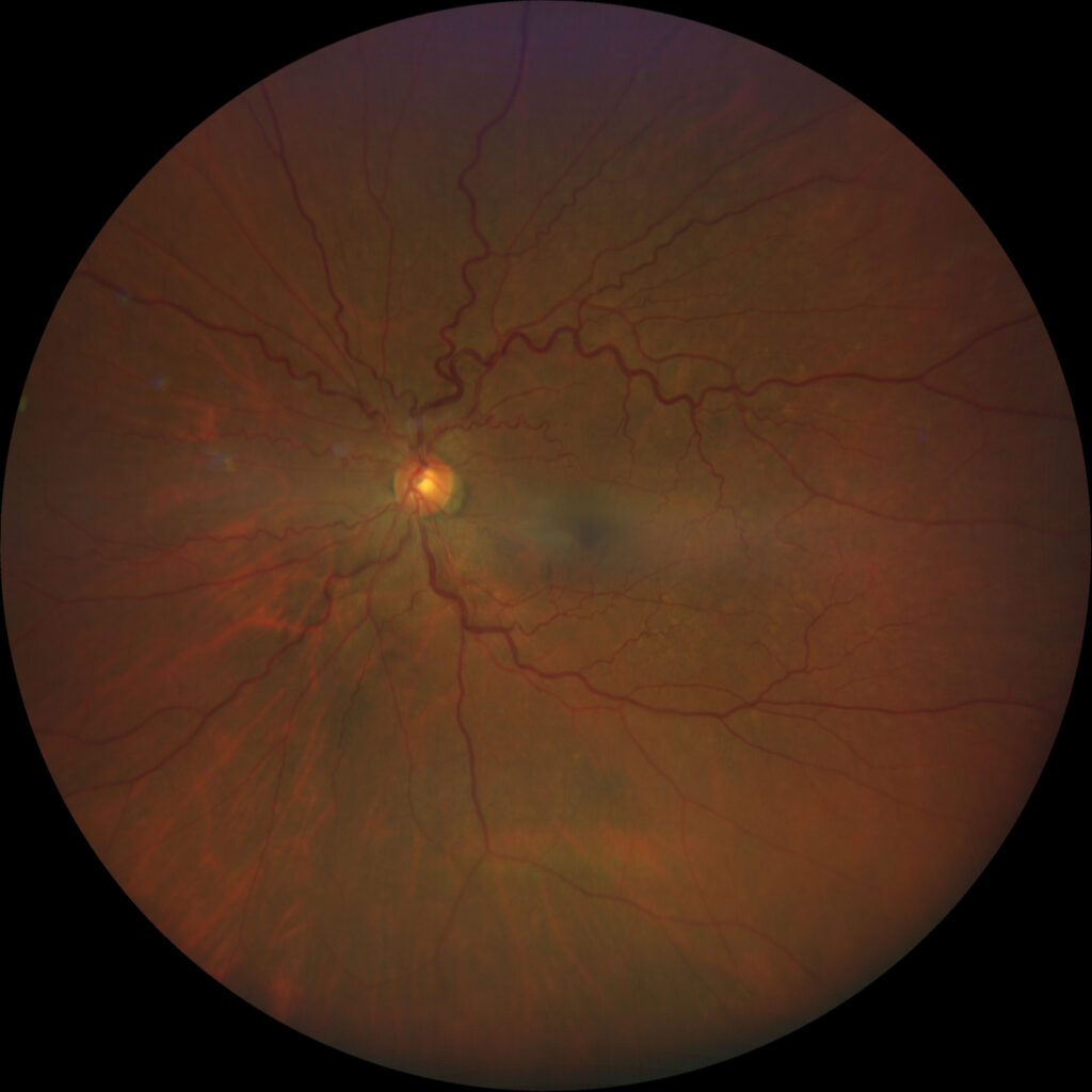 Clinical eye photograph illustrating Retinal Vessel Caliber Cardiovascular Risk