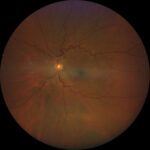 Clinical eye photograph illustrating Retinal Vessel Caliber Cardiovascular Risk
