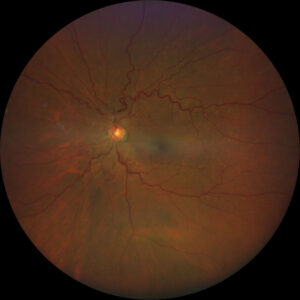 Clinical eye photograph illustrating Retinal Vessel Caliber Cardiovascular Risk
