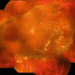 Clinical image illustrating Retinectomy (figure 1)