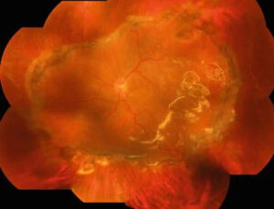 Clinical image illustrating Retinectomy (figure 1)