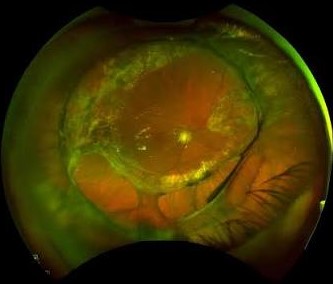 Clinical image illustrating Retinectomy (figure 2)