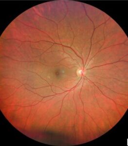 Clinical eye photograph illustrating Retinitis Pigmentosa Sine Pigmento