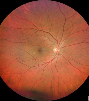 Clinical eye photograph illustrating Retinitis Pigmentosa Sine Pigmento