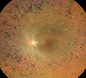 Clinical eye photograph illustrating Retinitis Pigmentosa Sine Pigmento